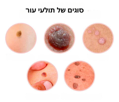 WipeOff™ - תג עור ומסיר שומות עור